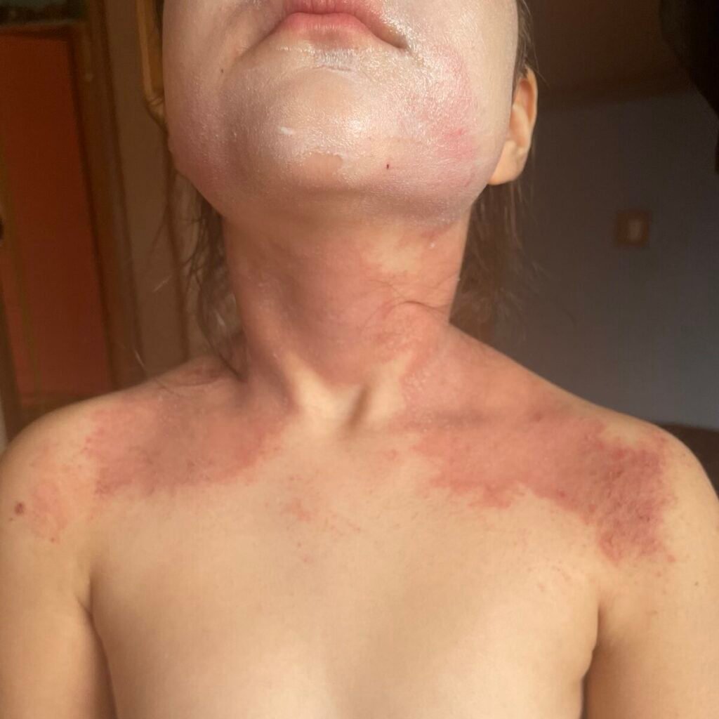 Infrardeča terapija_ InfraHeal_950_prej